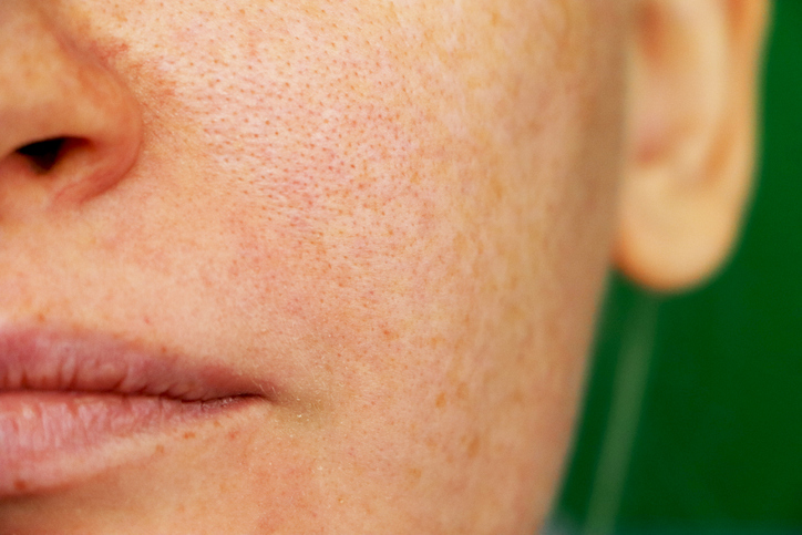 Close up of woman's face with freckles and pigmentation