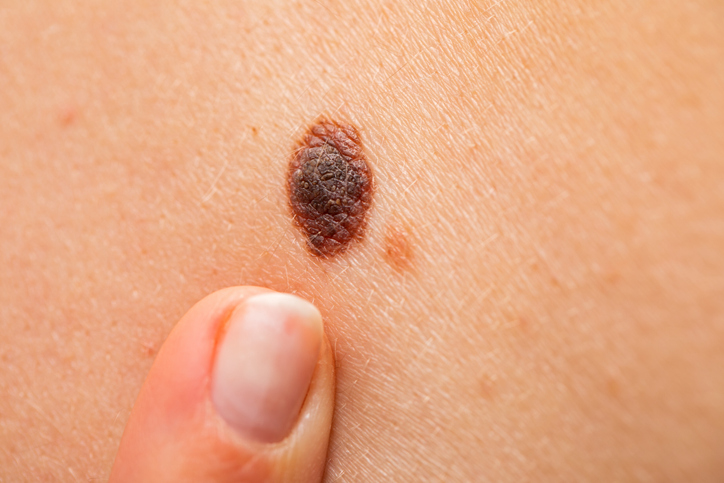 Close up picture of finger pointing at a brown mole on human skin