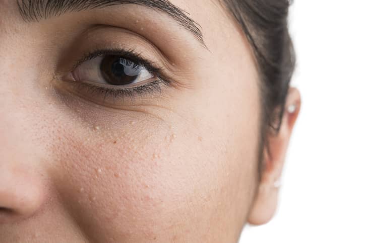 Close up shot of woman with plural milia on face