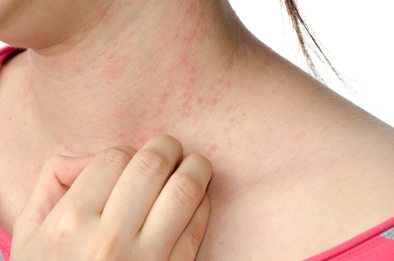 eczema-skin-on-neck