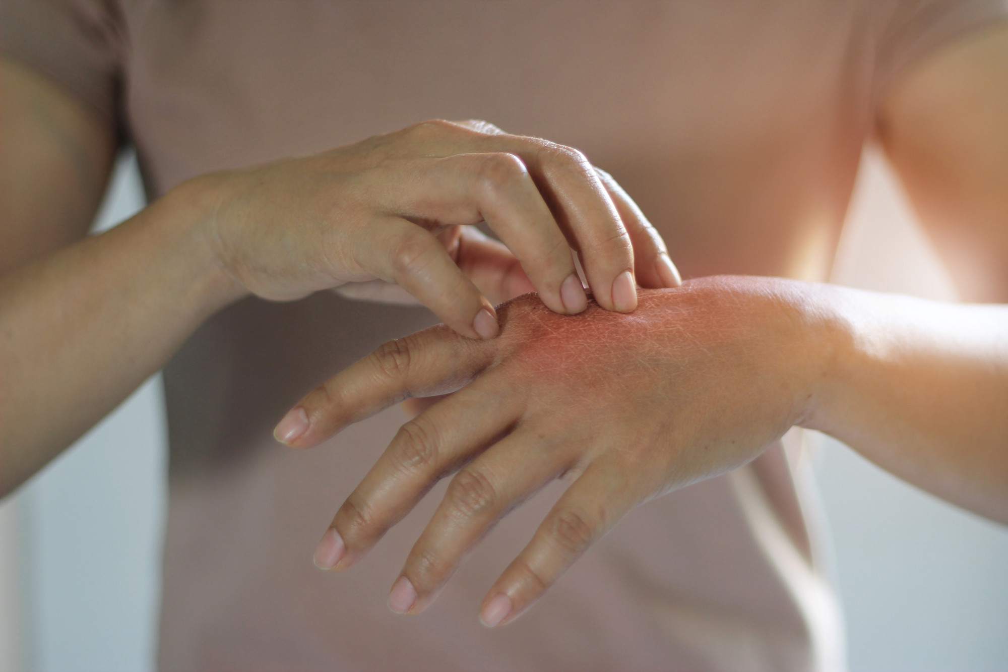 Woman with eczema