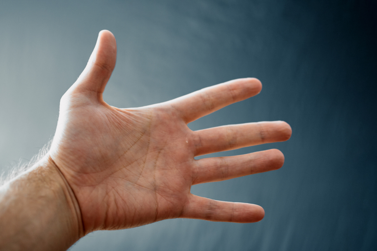 An adult hand with Raynaud's phenomenon.