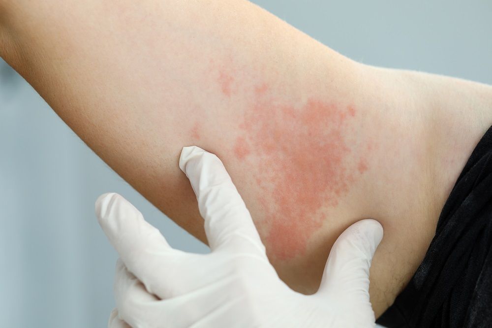 Hives - skin allergy