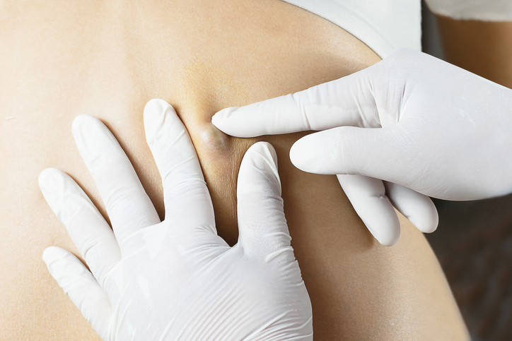 Credit: Doctor Diagnosis of the Sebaceous on Woman's Back