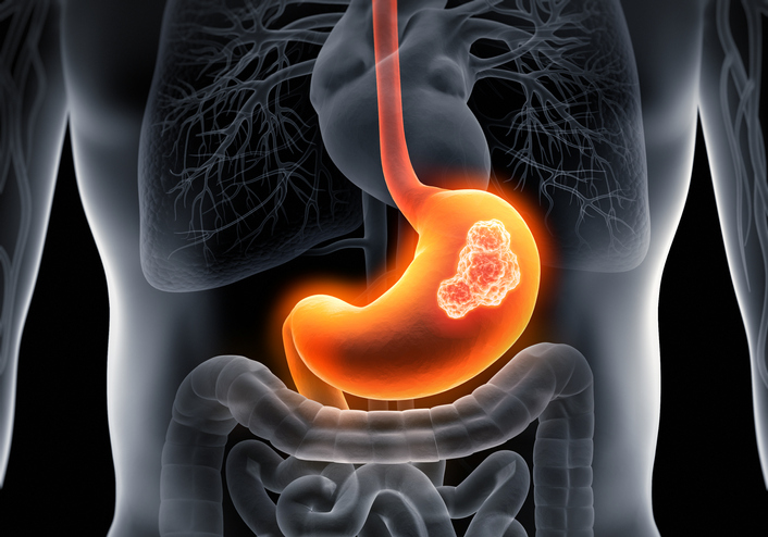 Medical x-ray illustration of stomach cancer with tumor