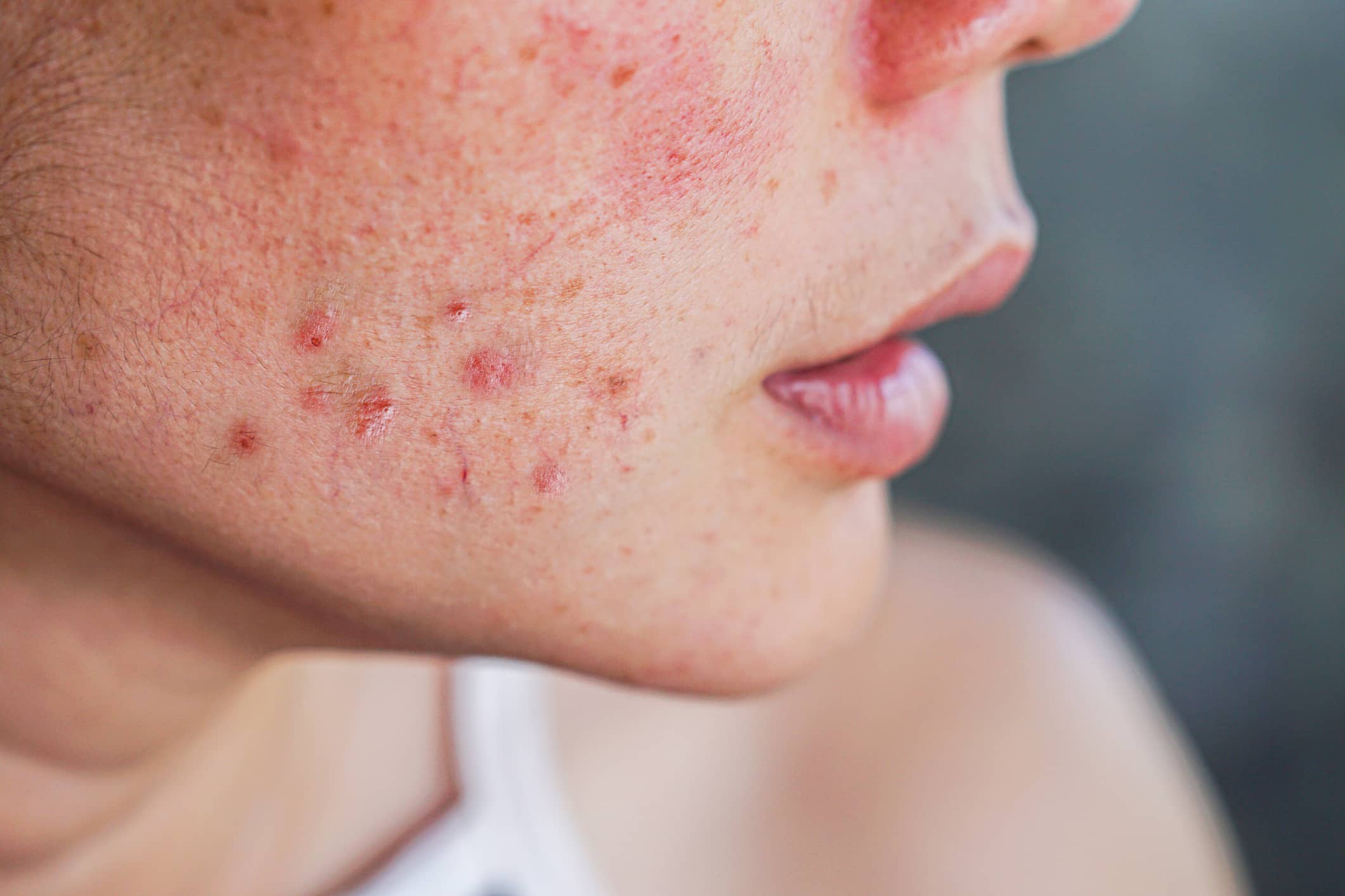 Menopause acne