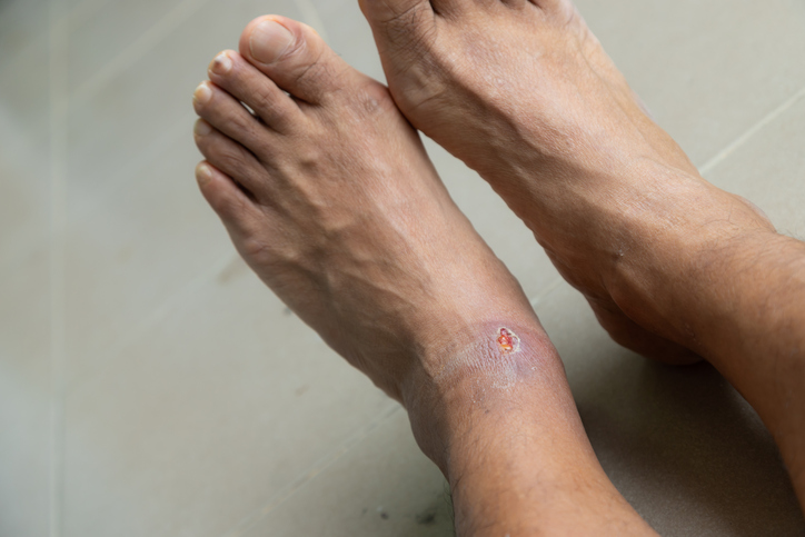 Skin ulcer on foot