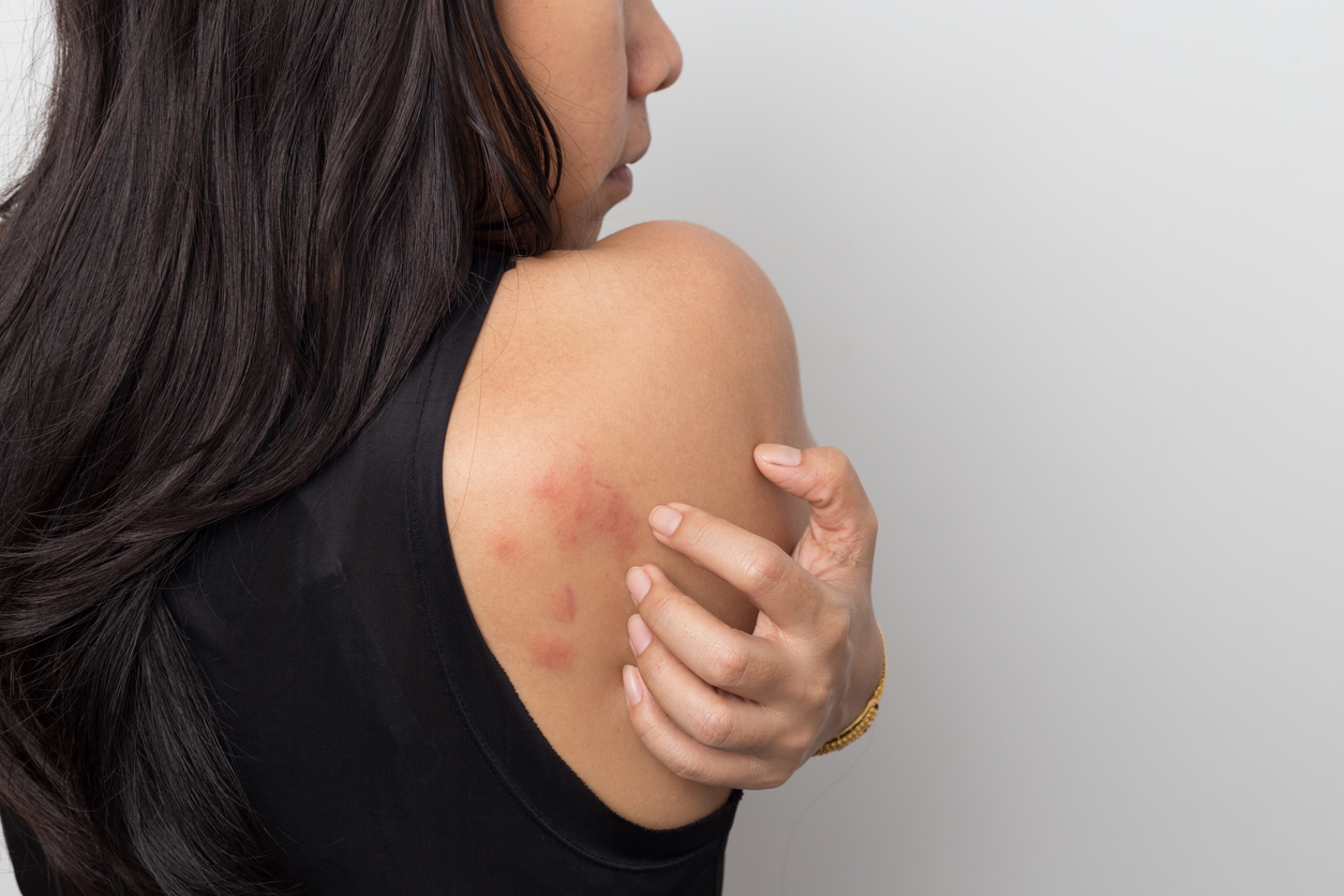 Woman scratching the red skin at the back of her shoulder