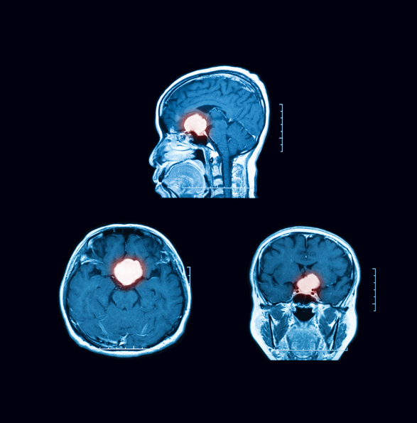 X-ray image showing carotid arteries and cerebral arteries