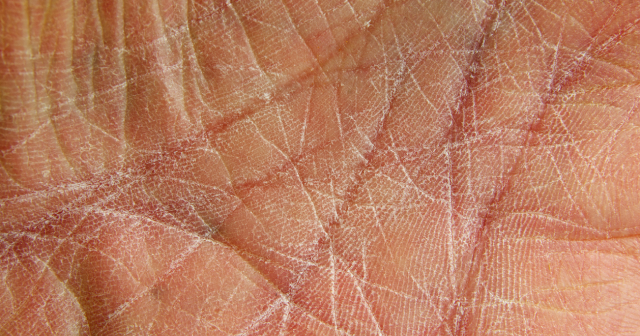 Mild dry skin on person's hand 