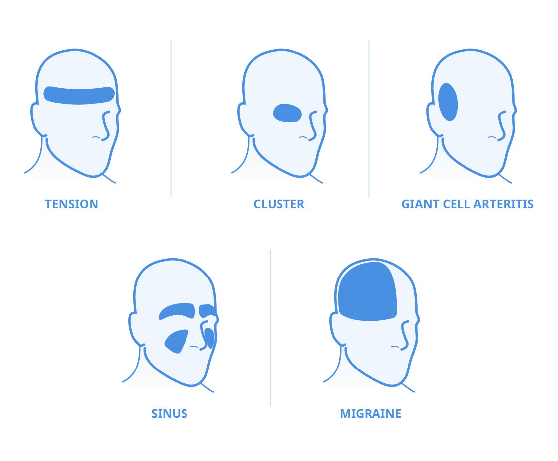 5 types of headache and their locations