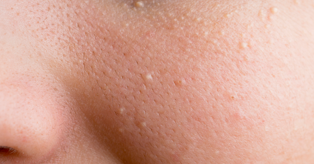 Milia are tiny white or yellow protein-filled bumps on your skin.